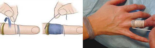 Как снять кольцо с пальца: как с помощью нитки удалить перстень с отекшего или опухшего пальца