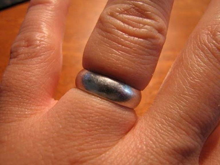 Как можно снять кольцо с отекшего пальца