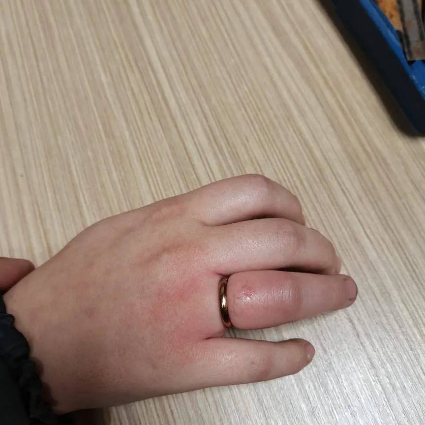 Как снять кольцо с опухшего и отекшего пальца: рабочий способ