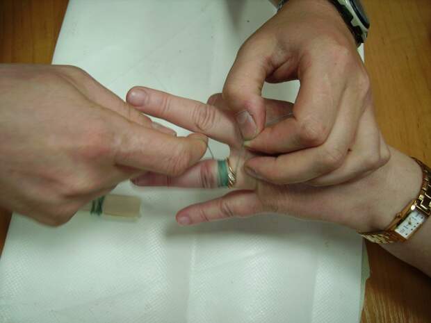 Как снять кольцо с опухшего пальца в домашних условиях с помощью нитки и других способов