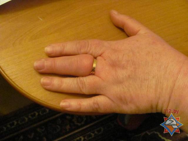 Как снять кольцо с опухшего пальца – 10 способов