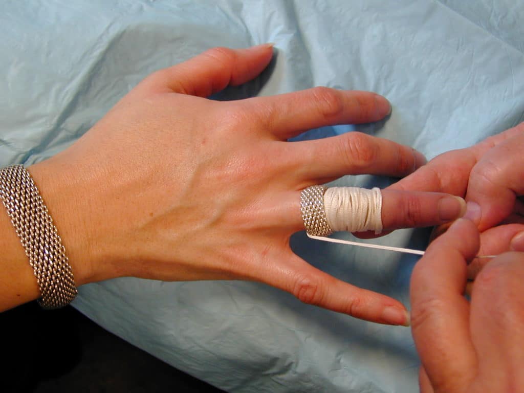 10 способов снять обручальное кольцо с опухшего пальца